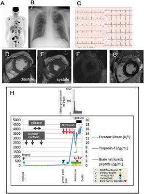 Non-canonical Expression of Cardiac Troponin-T in Neuroendocrine Ethmoid Sinus Carcinoma Following Immune Checkpoint Blockade